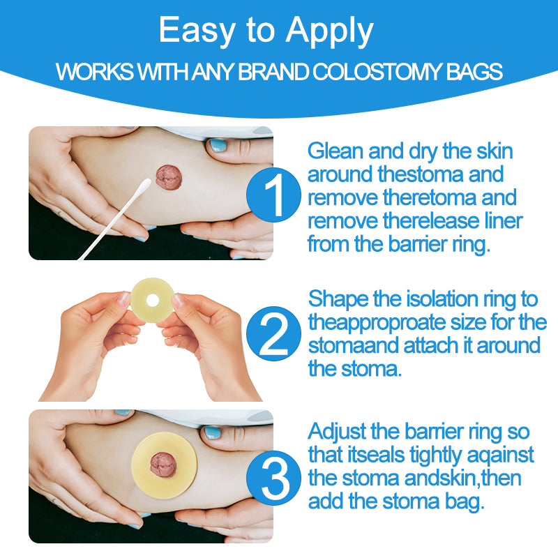 2 mm Ultra-Thin Stoma Leak-Proof Rings – 10-Pack Skin-Soft Seal, Instant Gap Fill & 24-Hr Zero-Leak Security