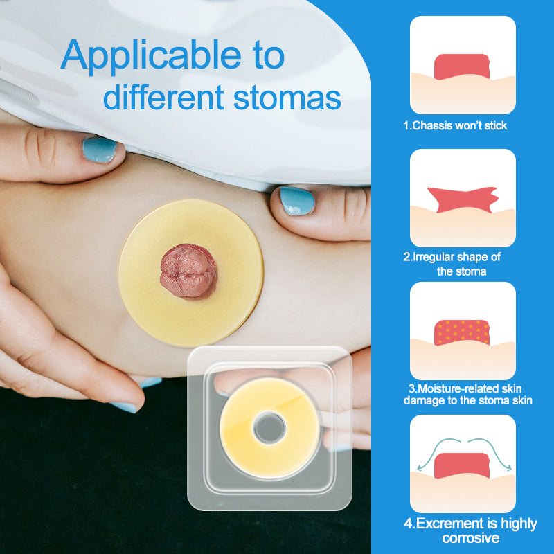 2 mm Ultra-Thin Stoma Leak-Proof Rings – 10-Pack Skin-Soft Seal, Instant Gap Fill & 24-Hr Zero-Leak Security