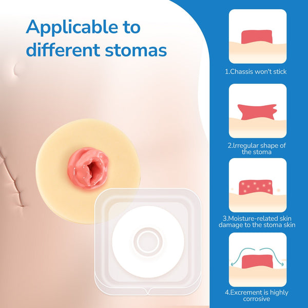 2 mm Ultra-Thin Stoma Leak-Proof Rings – 10-Pack Skin-Soft Seal, Instant Gap Fill & 24-Hr Zero-Leak Security